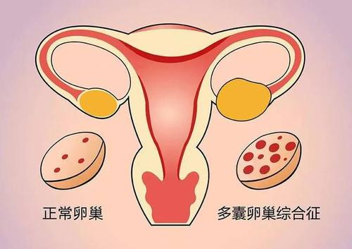 中医临床对多囊卵巢综合征病因病机的认识